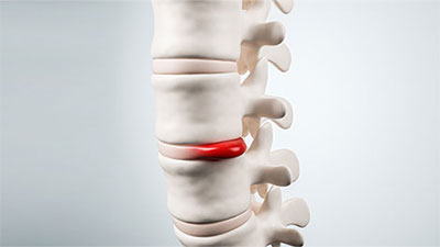 patient needs herniated disc chiropractor in Cupertino, CA