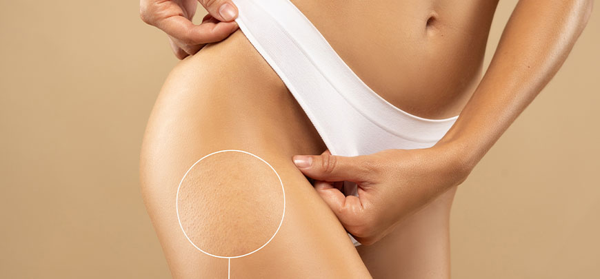 patient needing cellulite treatment in Cupertino