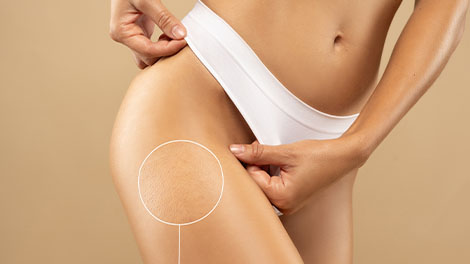 patient requiring cellulite treatment in Cupertino