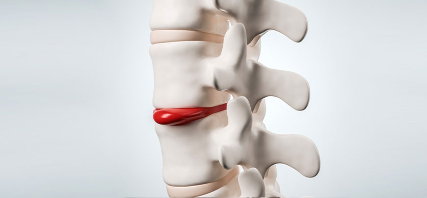 patient receiving herniated disc treatment in Cupertino