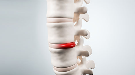 patient requiring disc injury treatment in Cupertino