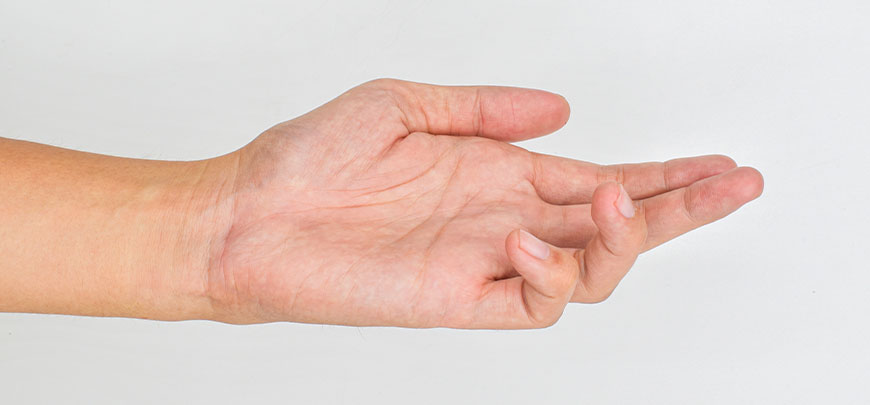patient needing dupuytren contracture treatment in Cupertino