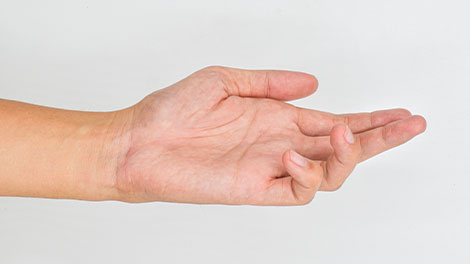 patient requiring dupuytren contracture treatment in Cupertino