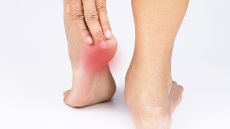 patient requiring plantar fasciitis treatment in Cupertino