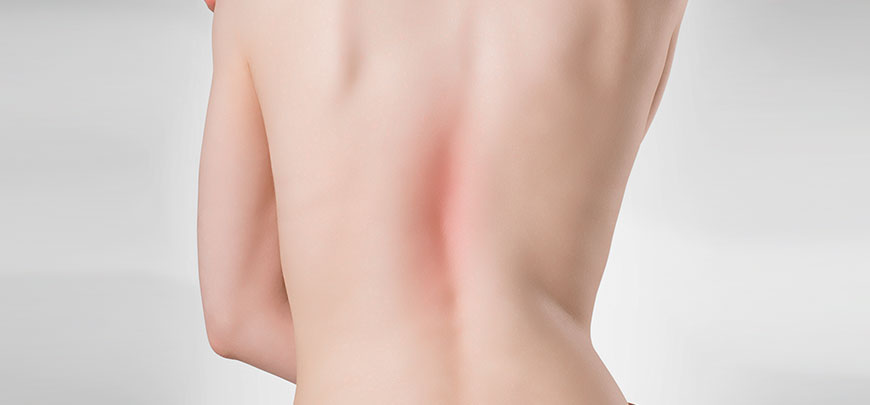 patient needing scoliosis treatment in Cupertino