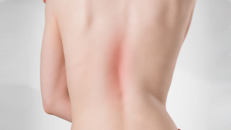 patient requiring scoliosis treatment in Cupertino