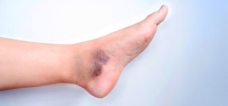 patient needing sprain treatment in Cupertino