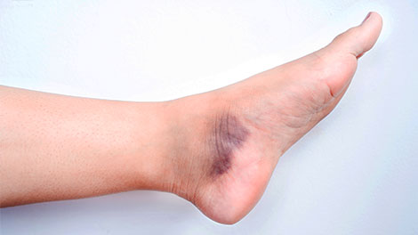 patient requiring sprain treatment in Cupertino