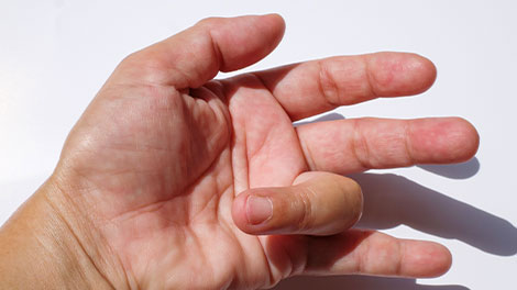 patient requiring trigger finger treatment in Cupertino